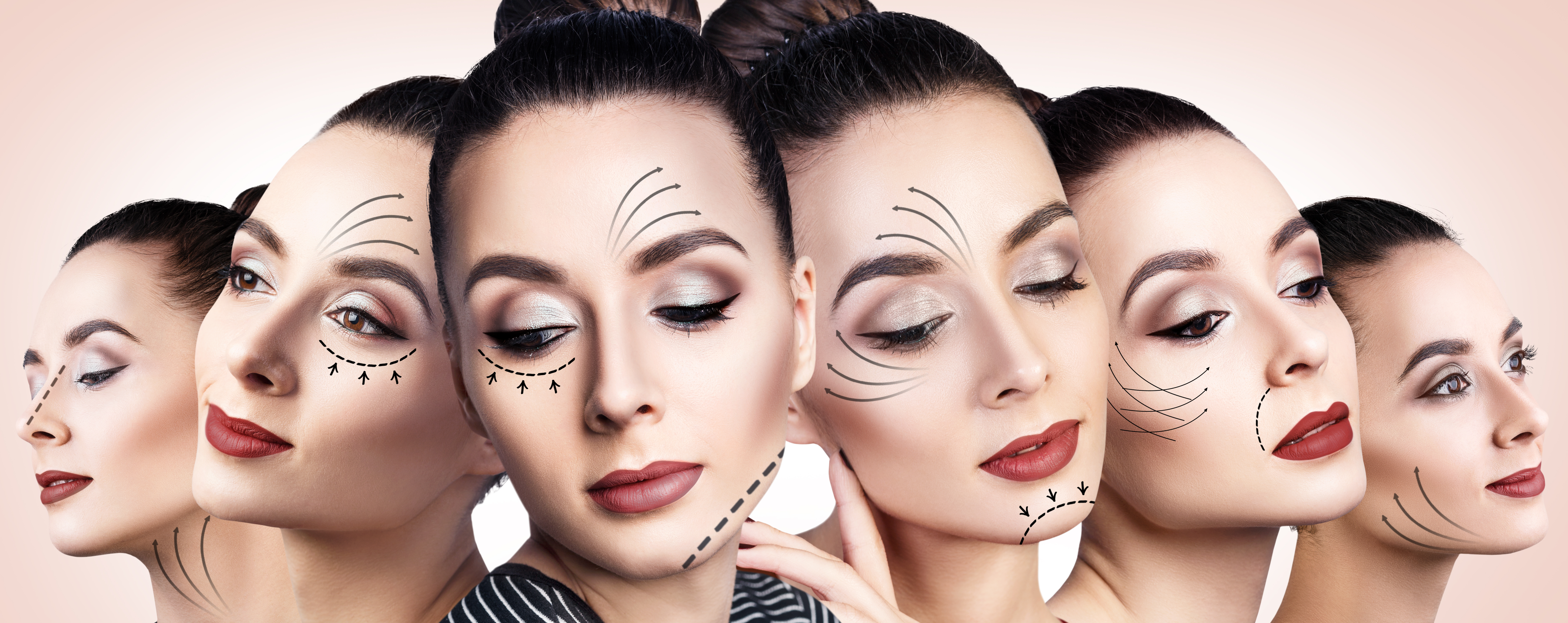 Gebieden deep plane facelift Gebieden deep plane facelift